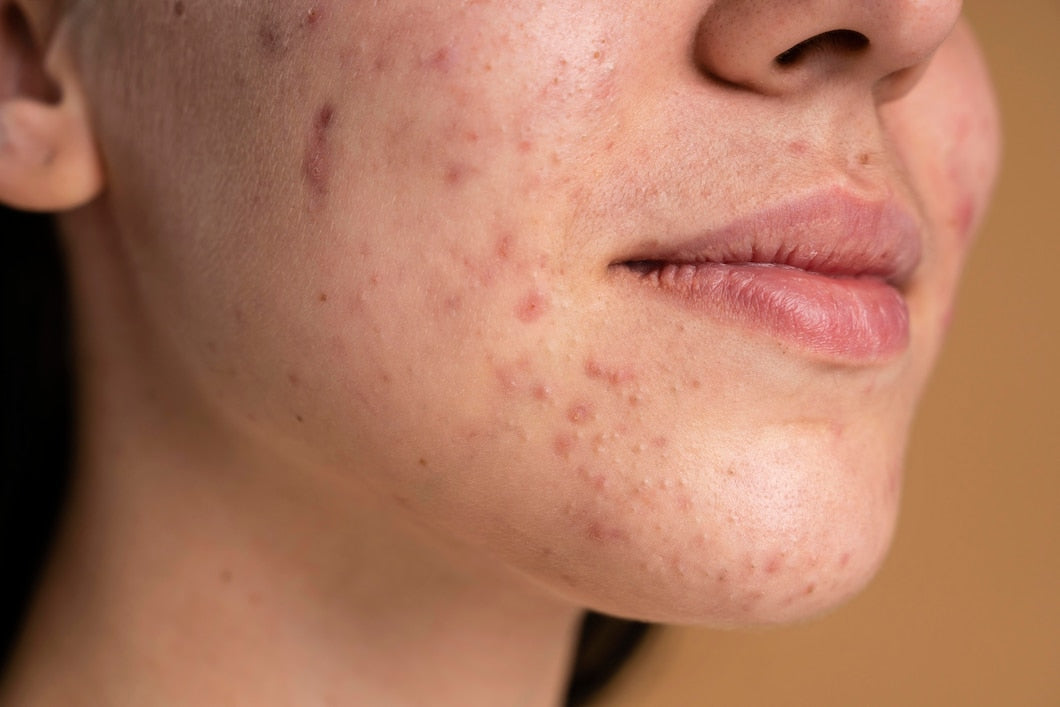 How to Treat Acne: Effective Skincare Tips & Treatments That Actually Work